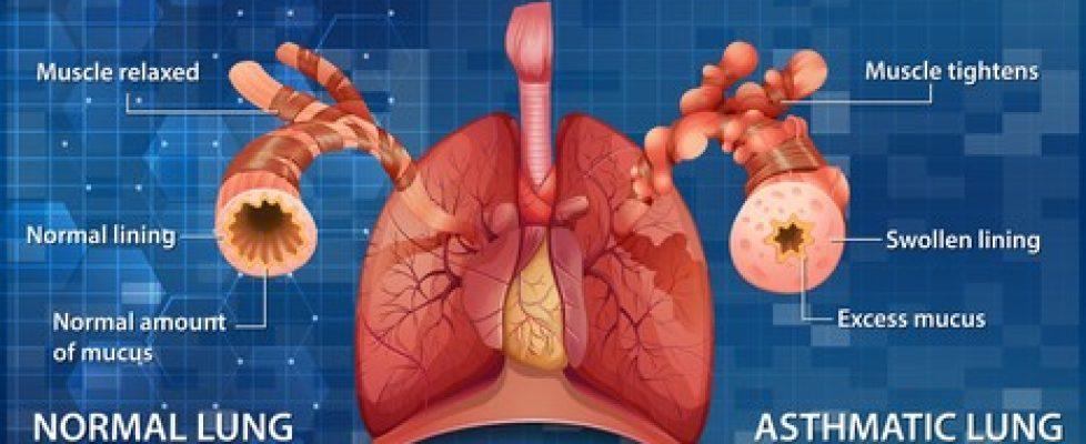 human-anatomy-asthma-diagram-illustration-260nw-1862260579 human-anatomy-asthma-diagram-illustration-260nw-1862260579